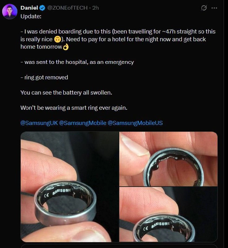 Samsung Galaxy Ring Battery Swelled on Finger Causing Hospital Emergency